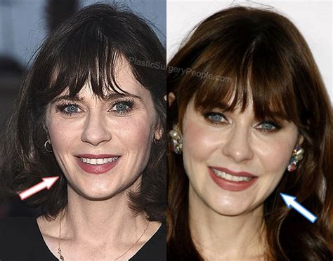 zooey deschanel plastic surgery|Zooey Deschanel: BEFORE and AFTER 2022.